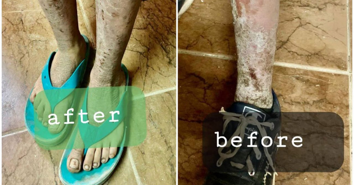 A child's skin from before and after.